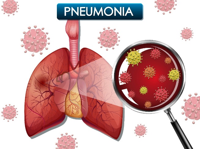 Pneumonia Selalu Mengintai Anak-Anak Kita, Ini Cara Mudah Pencegahannya menurut IDAI