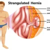 Turun berok atau hernia, gejala, penyebab, dan pengobatannya