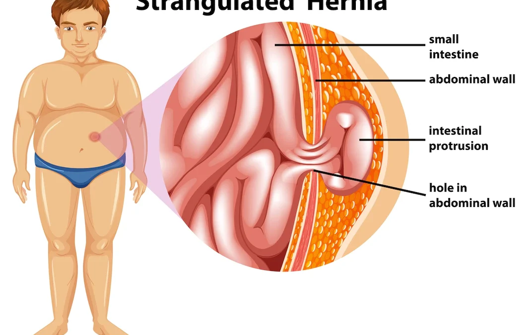 Turun berok atau hernia, gejala, penyebab, dan pengobatannya