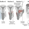 Mematikan!, Yuk Kenali Kanker Serviks Sejak Dini, Pengertian, 3 Gejala Awal, Faktor Risiko, Pencegahan dan Pengobatannya