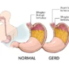 Penyakit Asam Lambung, Penyebab, Gejala, Pencegahan, dan Pengobatannya