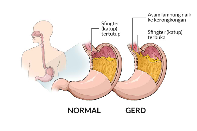 Penyakit Asam Lambung, Penyebab, Gejala, Pencegahan, dan Pengobatannya