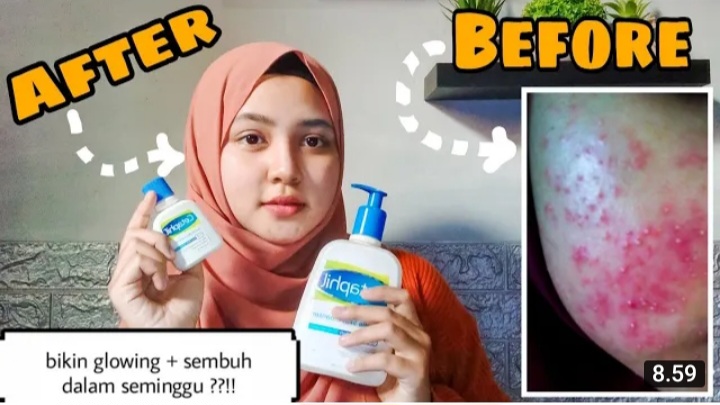 Produk cetaphil untuk mengatasi jerawat