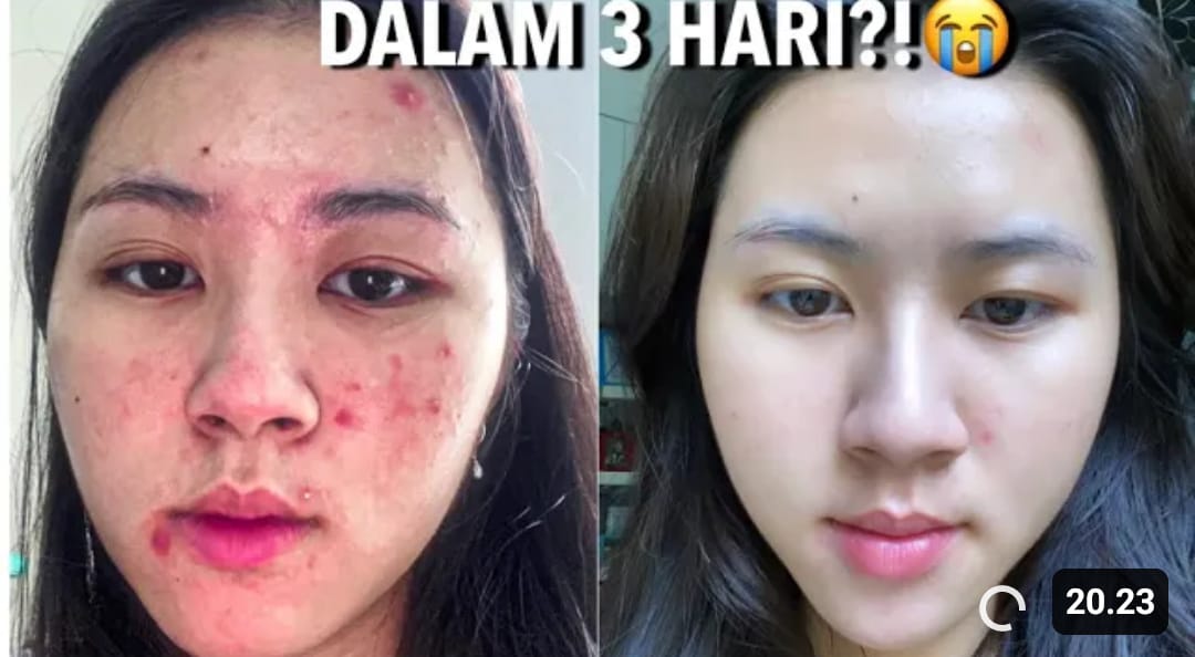 Sabun Cuci Muka Untuk Kulit Berminyak Berjerawat dan komedo