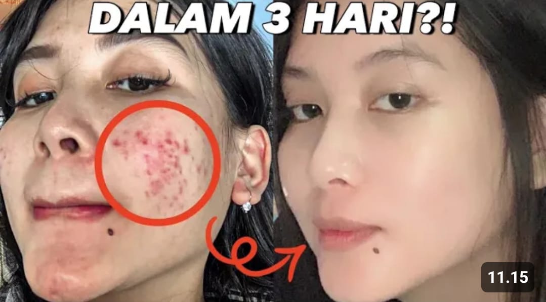 Serum untuk Mengecilkan Pori-Pori dan Menghilangkan Bekas Jerawat