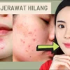 Solusi Menghilangkan Bekas Jerawat