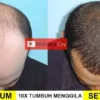 Cara cepat menumbuhkan rambut