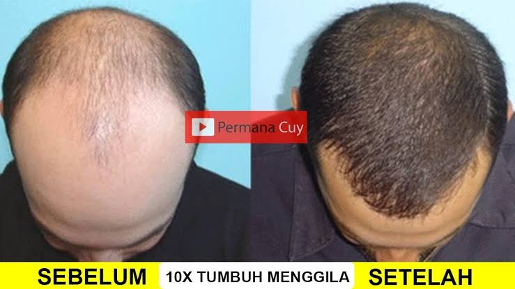 Cara cepat menumbuhkan rambut