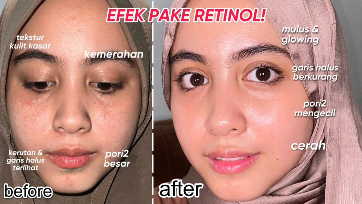 Cara memakai Retinol yang Benar