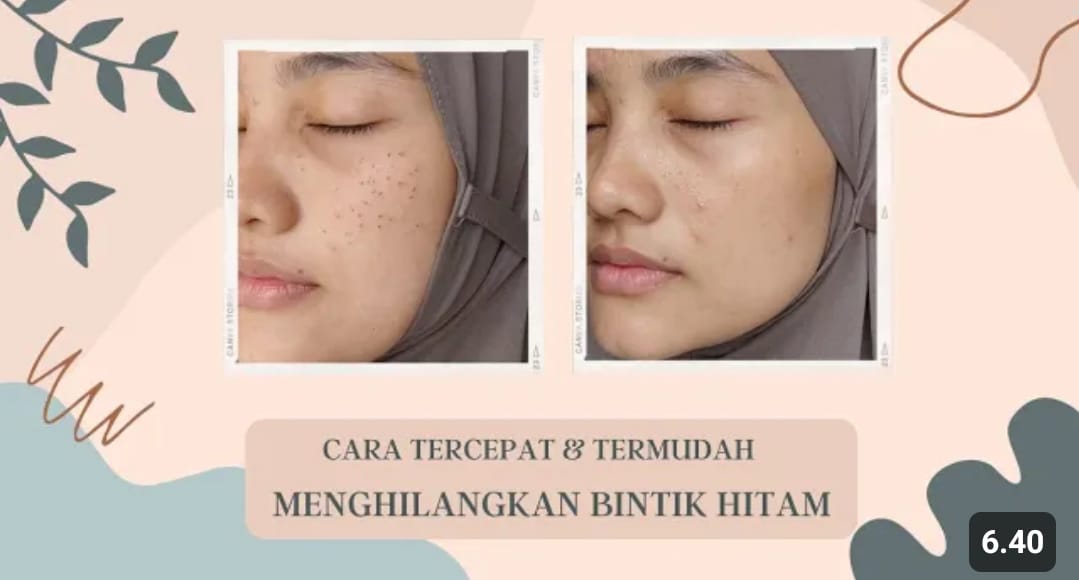 cara menghilangkan bintik hitam di wajah