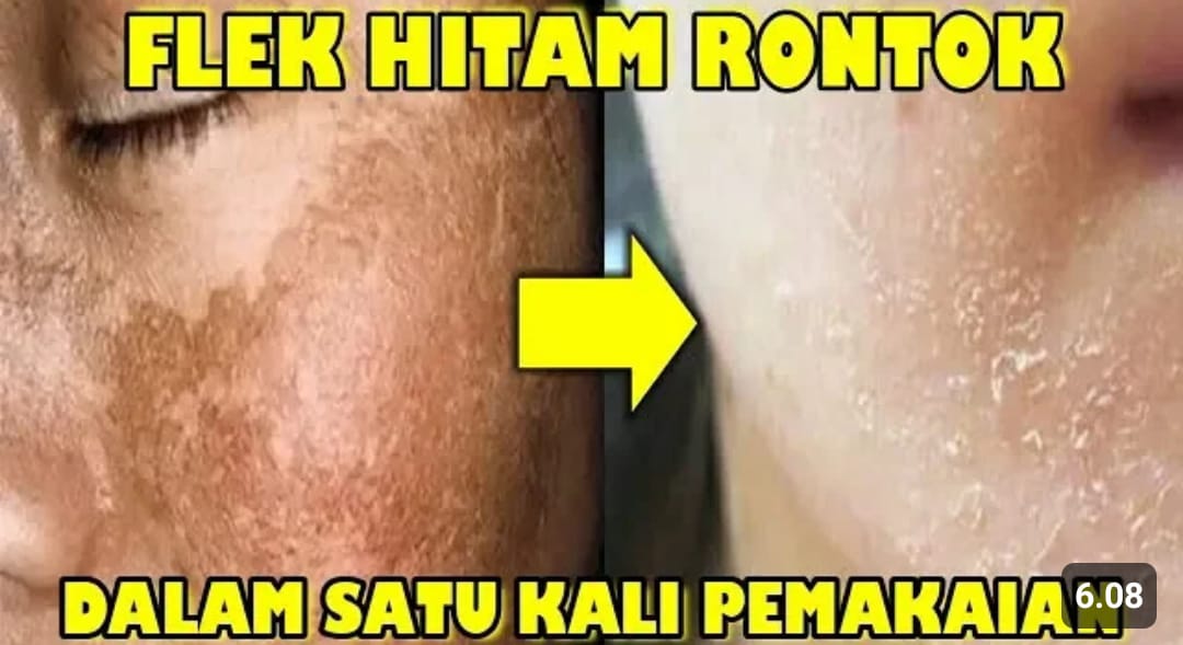 cara menghilangkan flek hitam