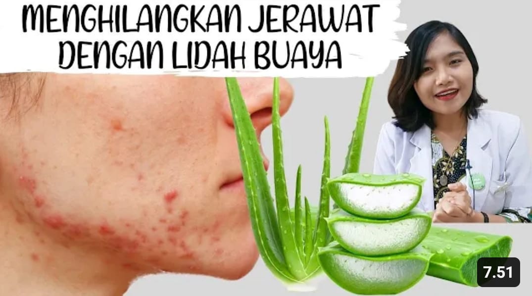 Cara menghilangkan jerawat dengan lidah buaya