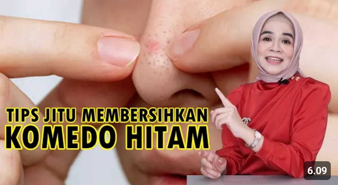 cara menghilangkan komedo hitam