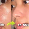 cara menghilangkan komedo di hidung