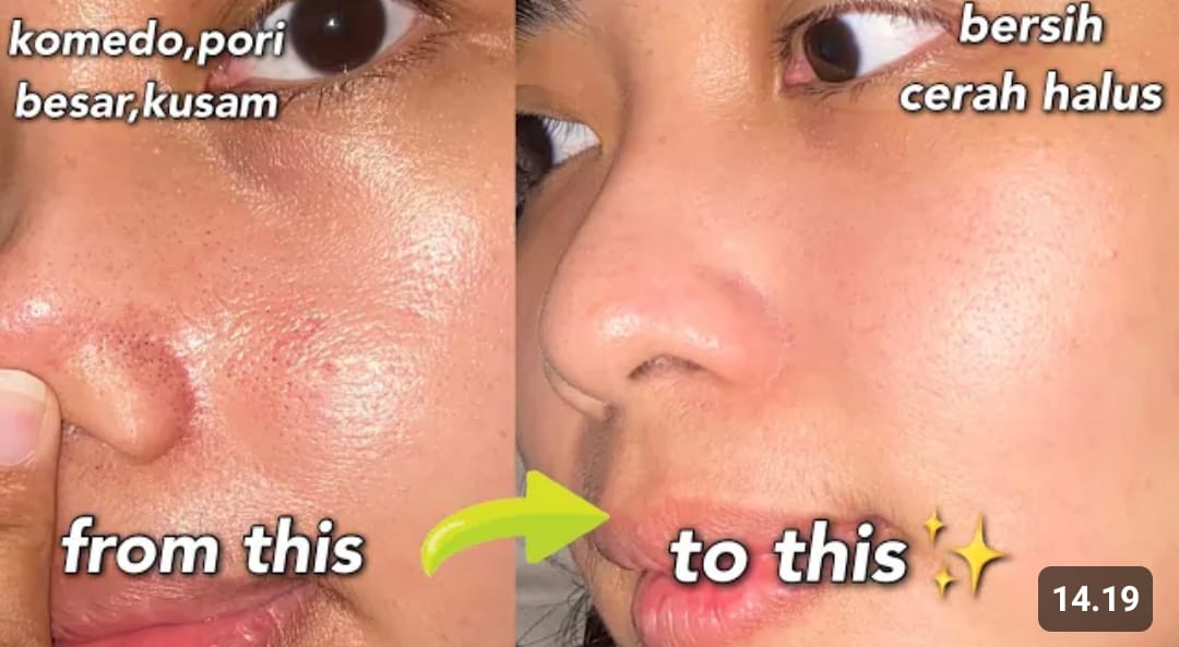 cara menghilangkan komedo di hidung