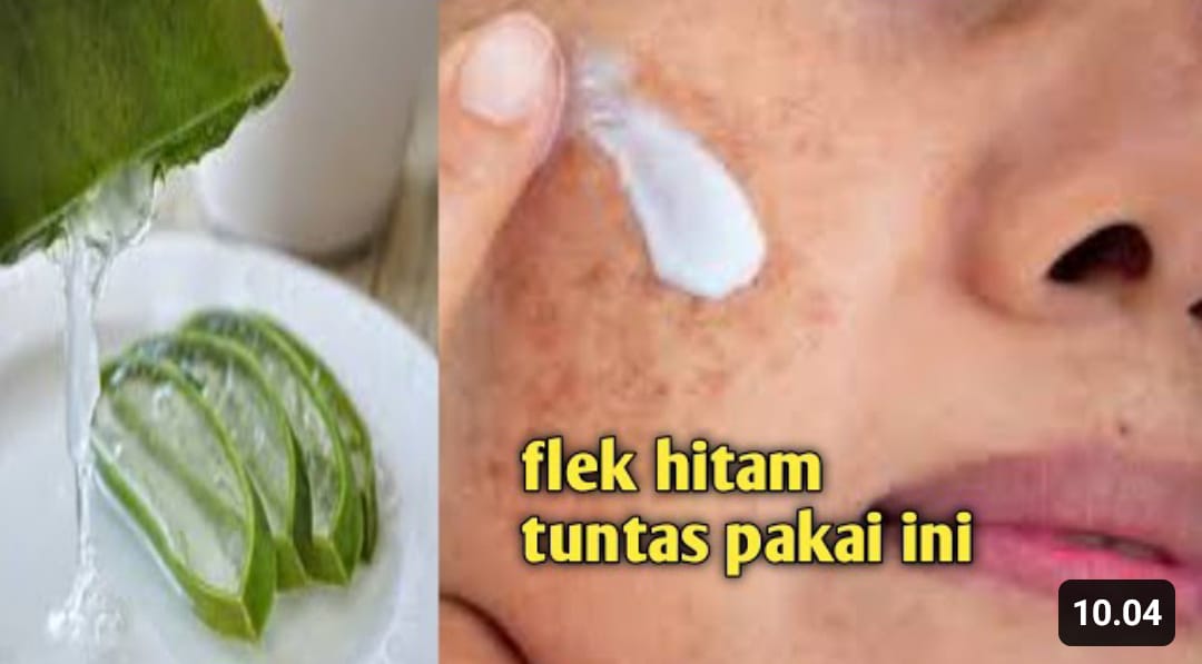 menghilangkan flek hitam dengan lidah buaya