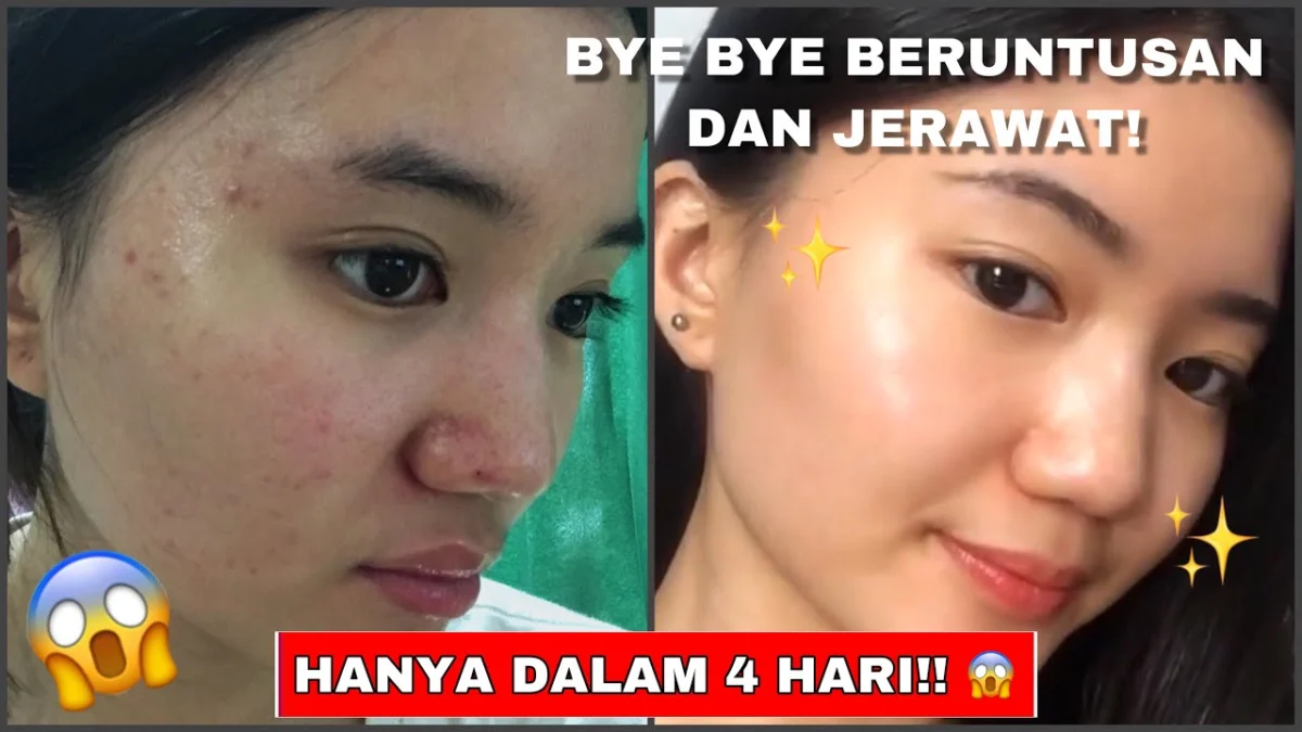 sabun muka untuk menghilangkan komedo dan jerawat untuk wanita