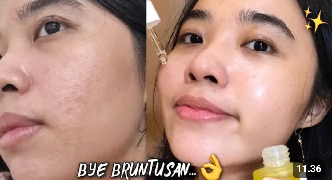 serum untuk menghilangkan bruntusan