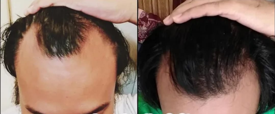 shampo penumbuh rambut dan penghilang uban