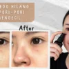 skincare untuk menghilangkan bekas jerawat dan mengecilkan pori pori