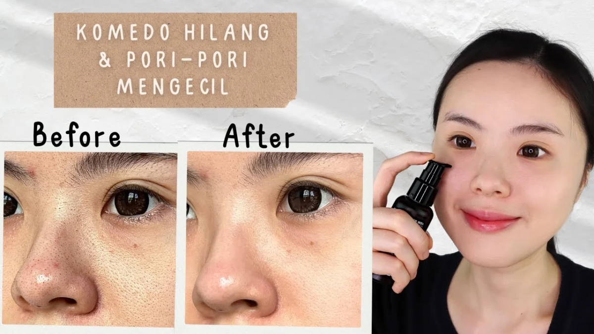 skincare untuk menghilangkan bekas jerawat dan mengecilkan pori pori