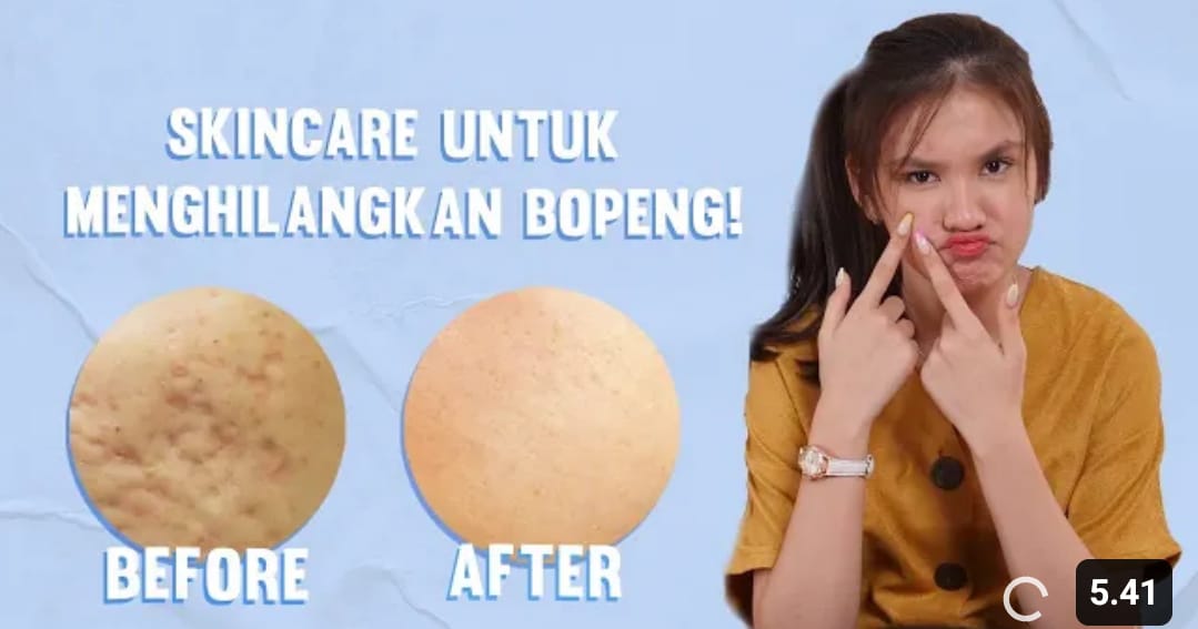 skincare untuk menghilangkan bopeng