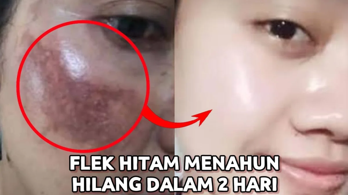 produk viva untuk menghilangkan flek hitam