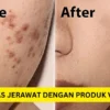 produk viva untuk menghilangkan jerawat dan bekasnya