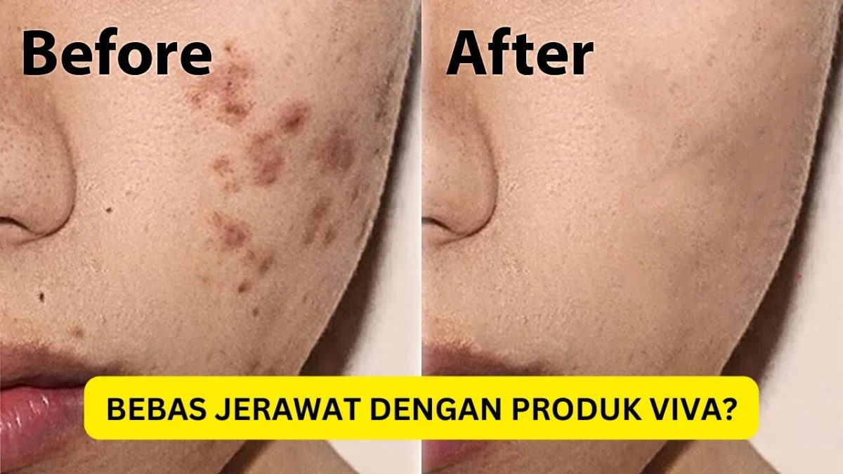 produk viva untuk menghilangkan jerawat dan bekasnya