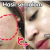 skincare viva untuk kulit berjerawat