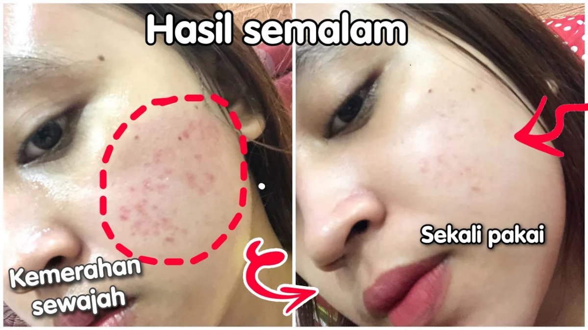 skincare viva untuk kulit berjerawat