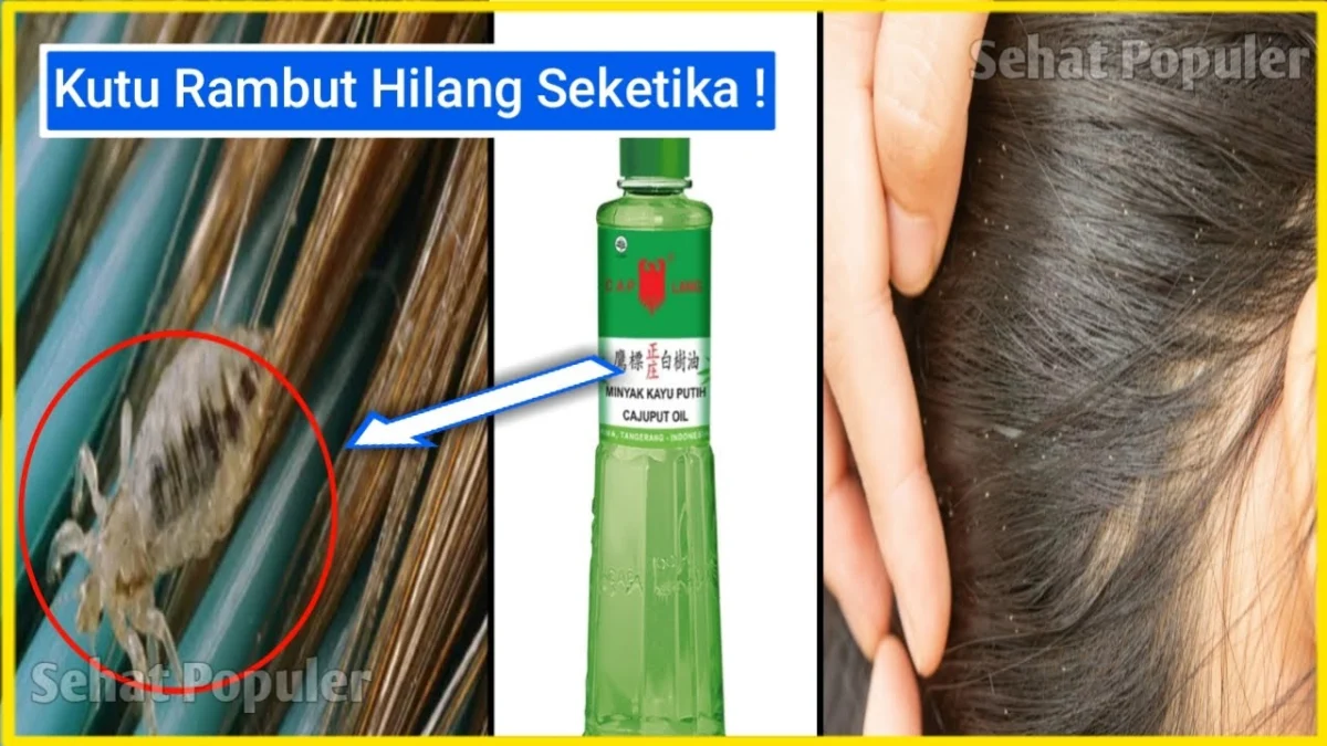 Cara menghilangkan kutu rambut dengan minyak kayu putih