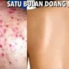 Sabun untuk Menghilangkan Jerawat di Punggung