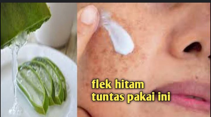 Flek hitam bisa hilang selamanya