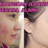 cara alami menghilangkan bekas jerawat