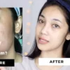 cara menghilangkan flek hitam di muka