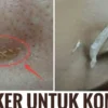 cara menghilangkan komedo dengan putih telur