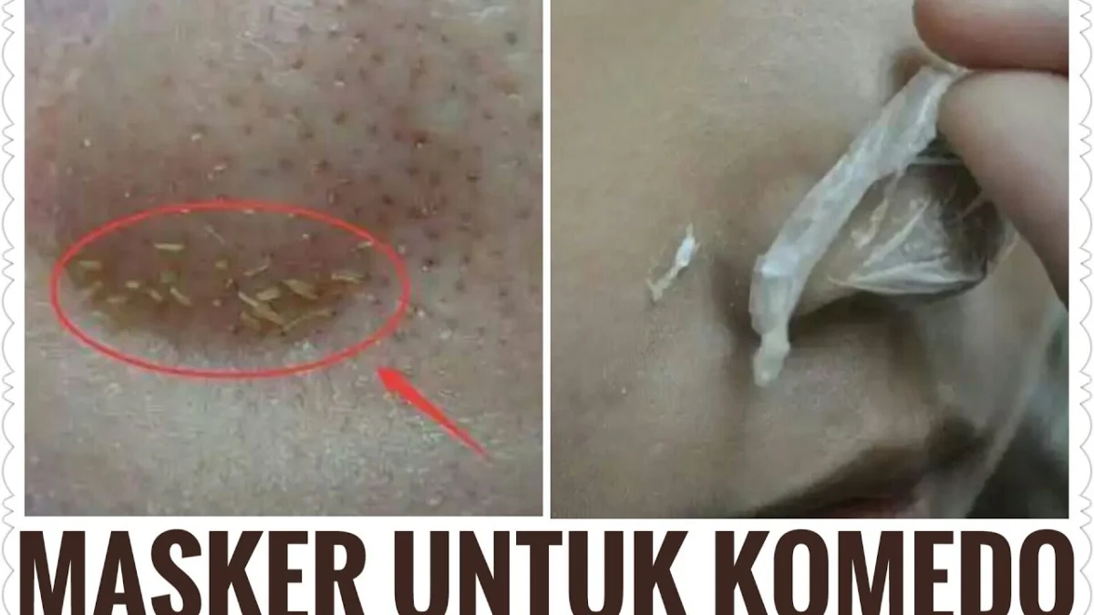 cara menghilangkan komedo dengan putih telur