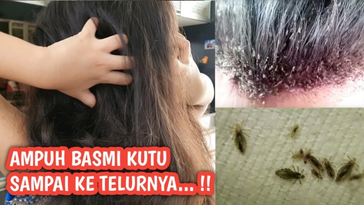 cara menghilangkan kutu rambut