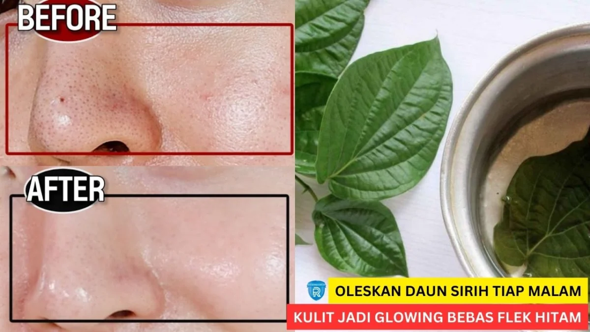 daun sirih buat masker wajah