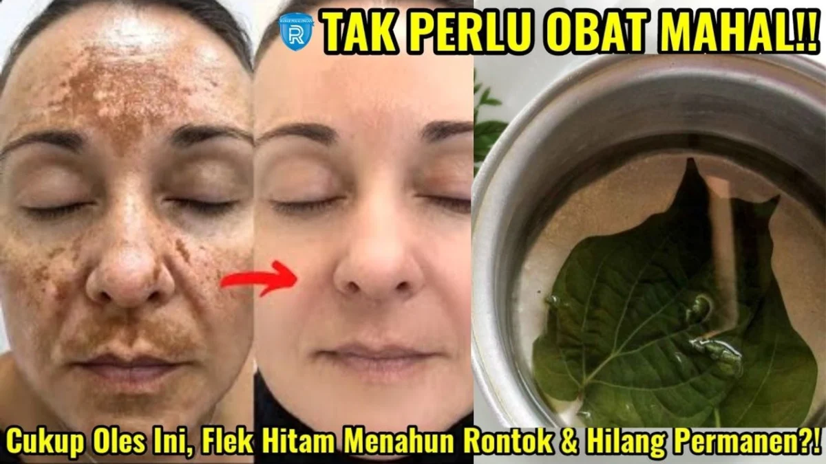 daun sirih untuk wajah