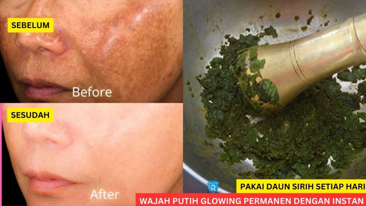 daun sirih untuk wajah glowing