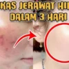 menghilangkan bekas jerawat secara alami