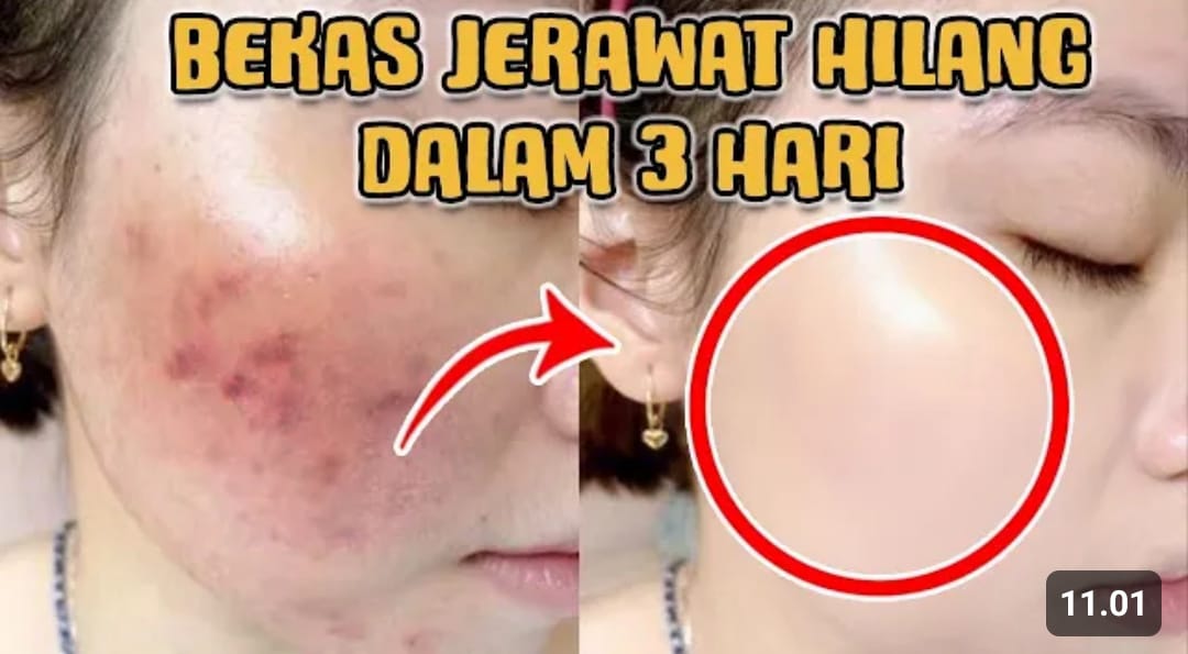 menghilangkan bekas jerawat secara alami