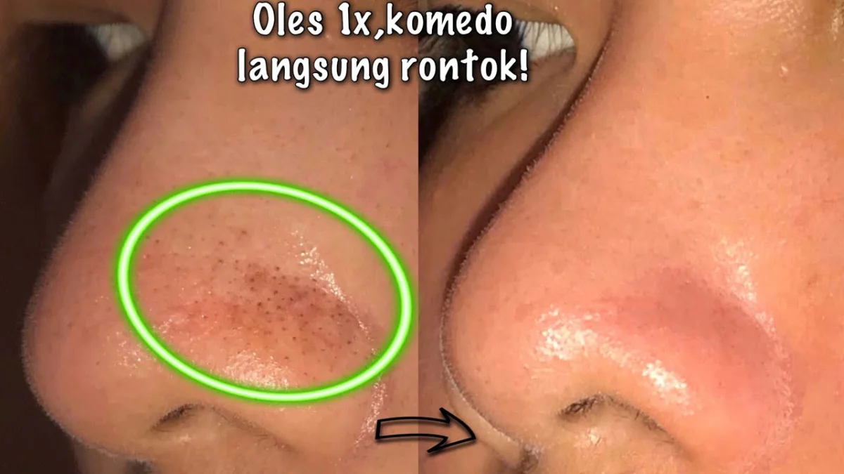 menghilangkan komedo di hidung secara alami