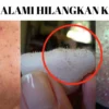 menghilangkan komedo hitam di pipi secara alami