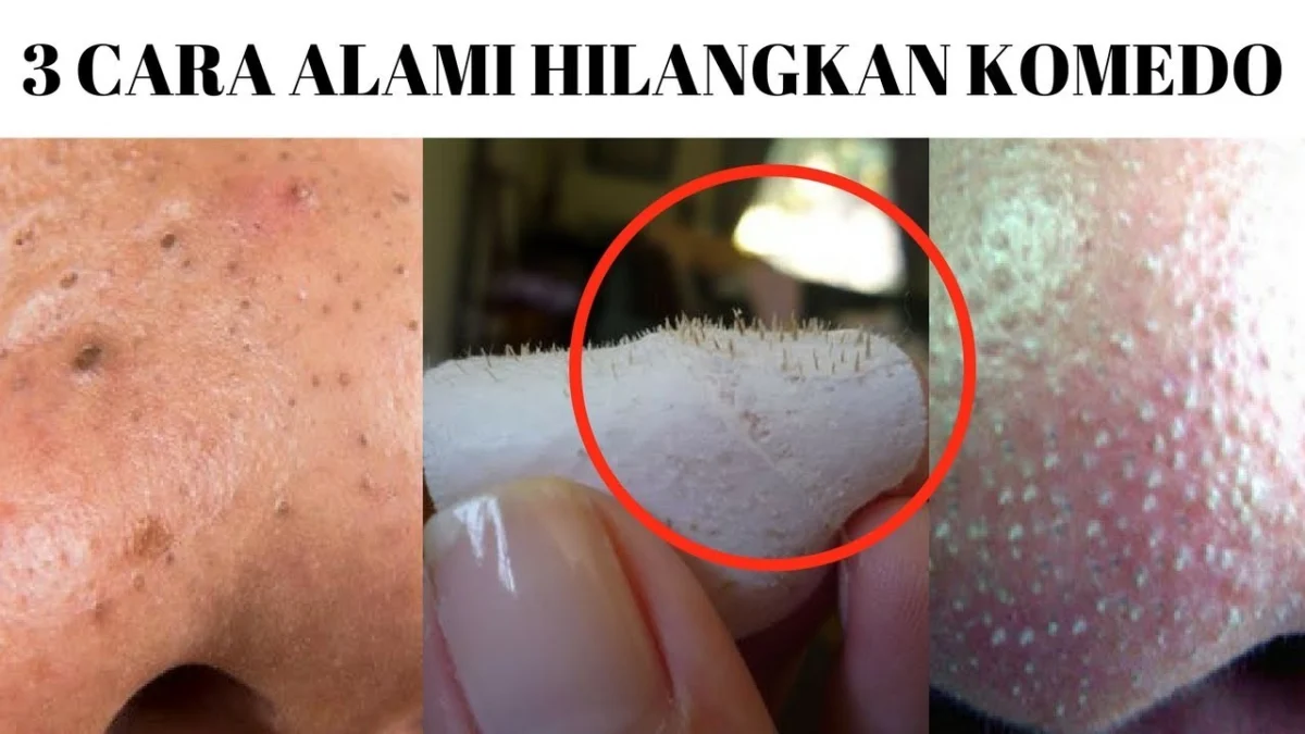 menghilangkan komedo hitam di pipi secara alami