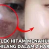 penghilang flek hitam di wajah