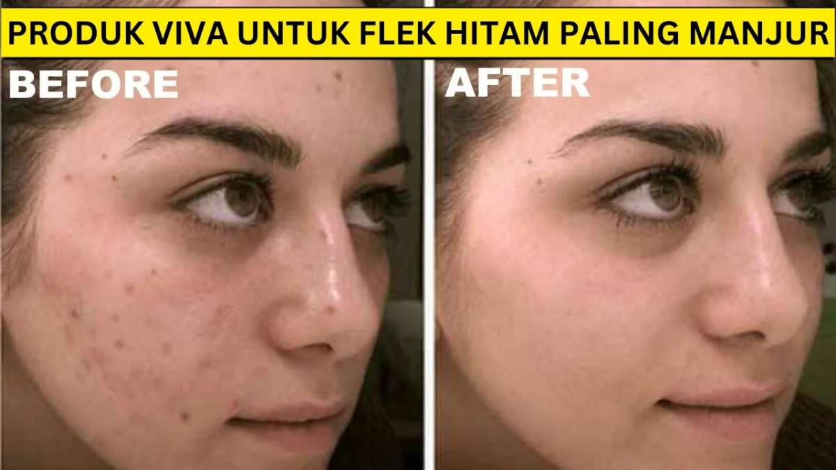 produk viva untuk flek hitam