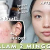 skincare lokal untuk menghilangkan komedo dan mengecilkan pori-pori